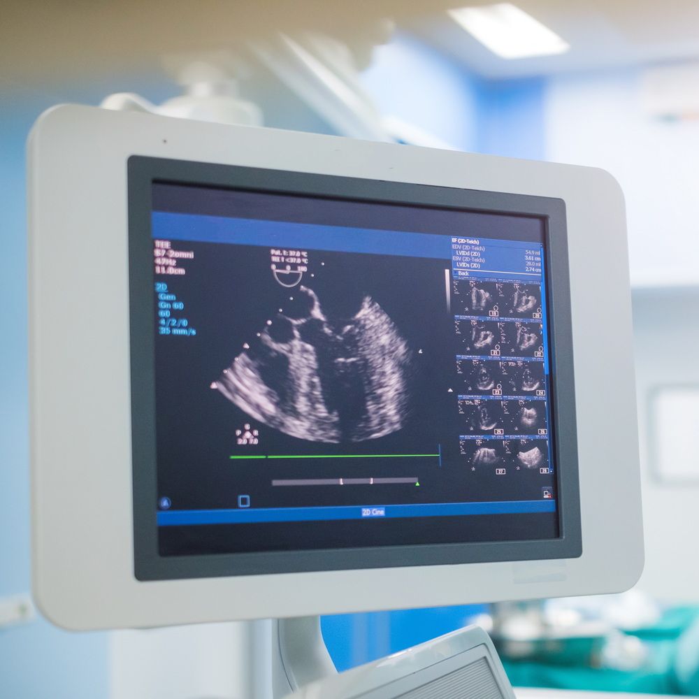 An image of a heart being imaged by an Echocardiography Machine. ECHO machines are available at all Townsen Imaging Centers.
